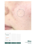 [ 現貨 ] P.calm 超隱形痘痘貼 ( 化妝都隱形! )