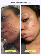 [ 店主自留 Pre-order ] Krave Beauty  Great Barrier Relief 45ml